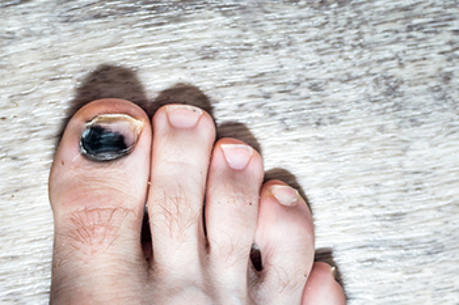 Toenail Falling Off? Here's What to Do