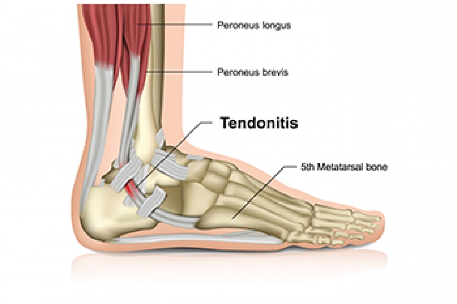 Achilles Tendon Pain: Causes, Diagnosis and Treatment